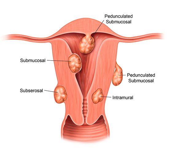 diagram of the womb with fibroids